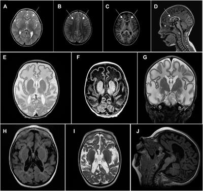 Case Report: Two Families With HPDL Related Neurodegeneration